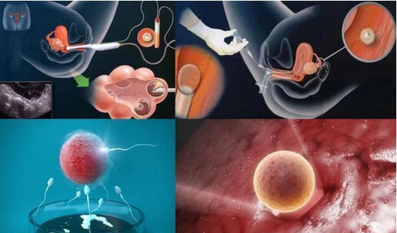 人工授精卵泡多大做的成功率高？附成功率影响因素